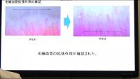 冷えと毛細血管の関係